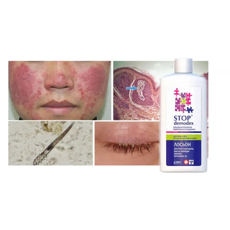 STOP Demodex Tonic Face Tonic for nausea acne blackheads - Laroxy.com