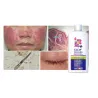 STOP Demodex Tonic Face Tonic for nausea acne blackheads - Laroxy.com