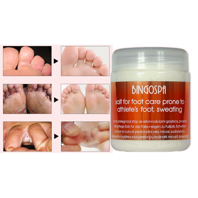 BingoSpa Salt for toenail fungus REFUSALIZATION OF HEADS ❤️ Laroxy