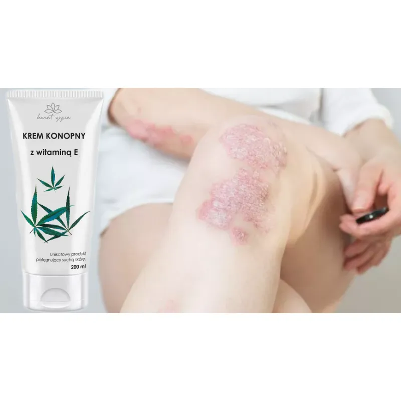 Flower of Life ointment for eczema psoriasis ADS with vitamin E HORSE 🌳 Laroxy