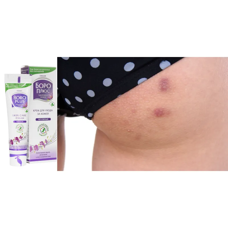 BORO PLUS HERBAL Maść na krosty na pupie pryszcze wypryski na pośladkach bolące z cynkiem 25ml