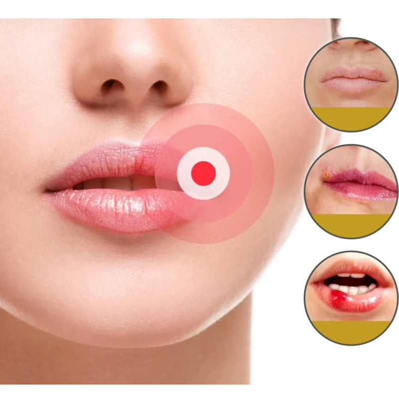 Protective breathable herpes patches 15 pieces ❤️ Laroxy