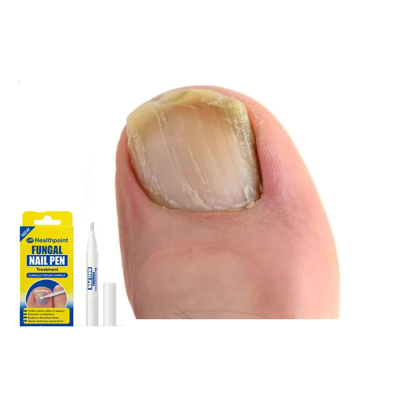 Formulations for toenail fungus preparation MOCNY ❤️ Laroxy.pl