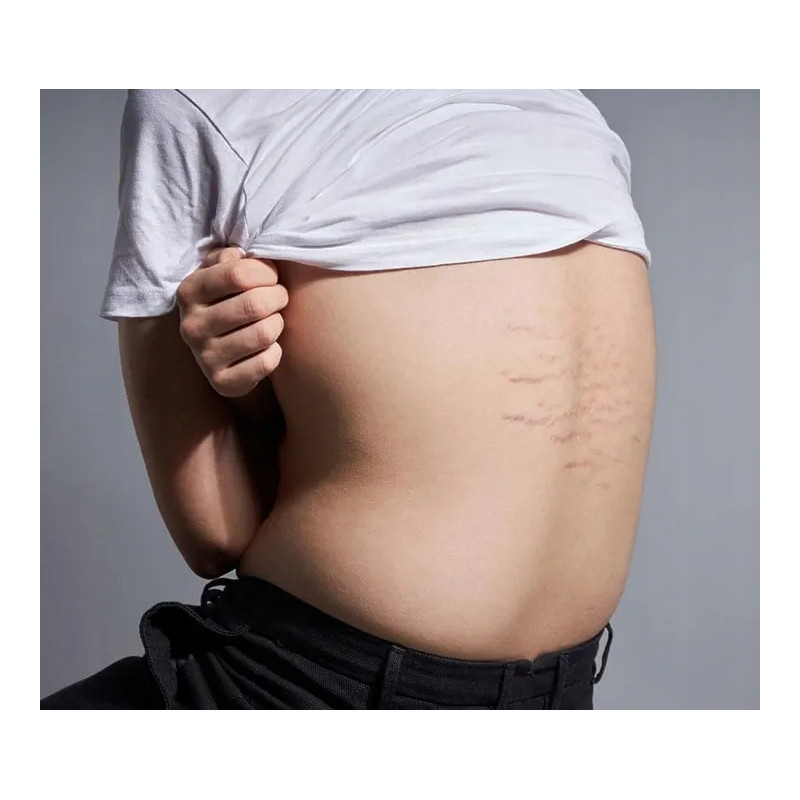 Palmers good stretch mark cream for teens ❤️ Laroxy.co.uk